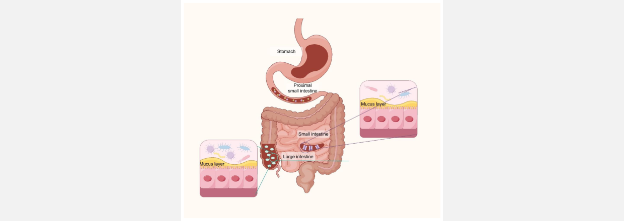 Irritabel tyktarm (IBS)